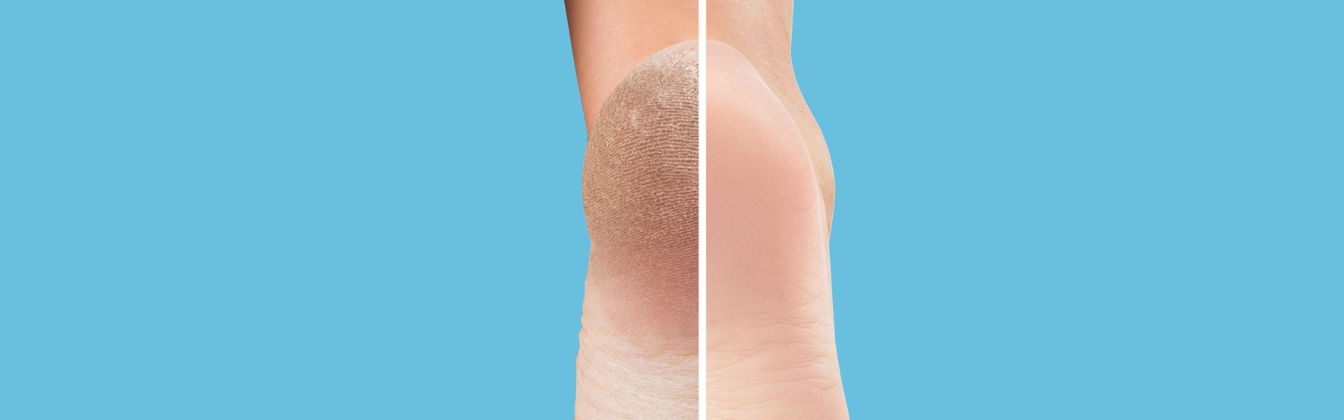 Pękające pięty – poznaj sposoby, jak sobie z tym problemem radzić?