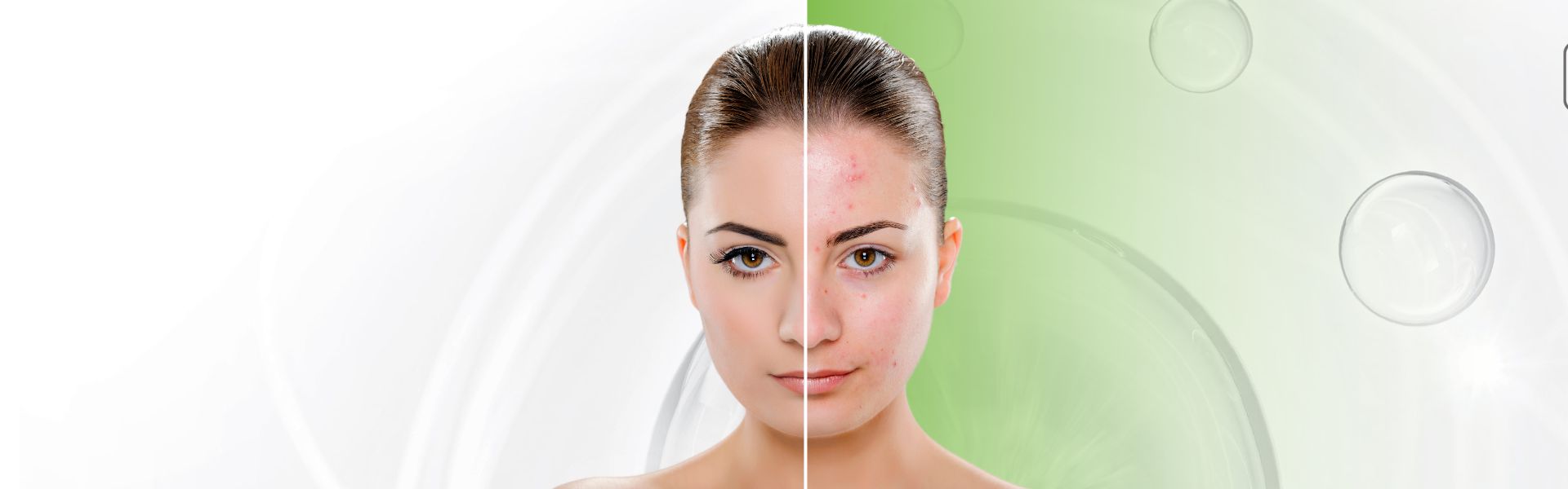 Najlepsze Kosmetyki na Trądzik: Kompleksowa Terapia Acne Free ProExpert od Bielenda Professional